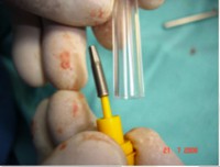 /album/galeria-de-fotos-carga-imediata-apos-exodontia-atraumatica-/carga-imediata-com-exodontia-atraumatica4-jpg/